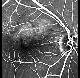 Oclusión de la rama venosa de la retina